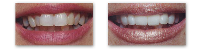A before and after photo of an OKC Smiles porcelain veneers patient.