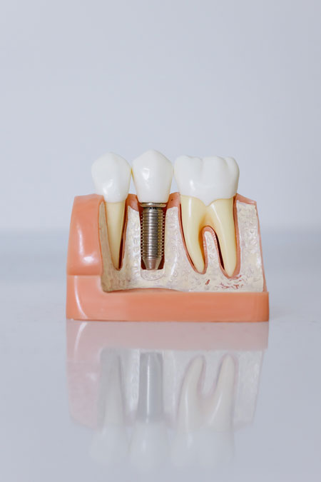 A model with a dental implants single implant example.
